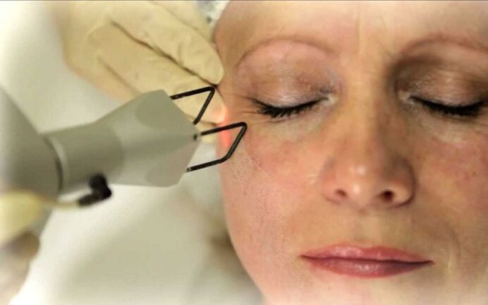 Laser kau da wrinkles a kusa da idanu