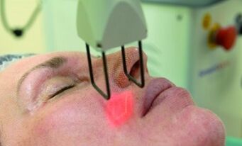 aiwatar da hanyoyin sabunta laser juzu'i